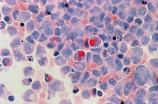 白血病早期症状-小红点皮疹需引起注意
